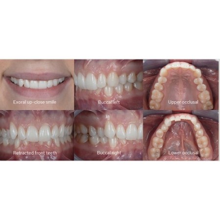 GODOX MF12-K2 KIT FLASH MACRO RING